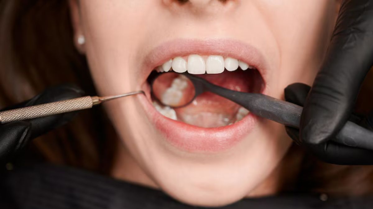 Why Experts Now Say Not to Remove Your Wisdom Teeth
